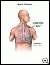Thumbnail image of: Pleural Effusion: Illustration
