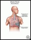Thumbnail image of: Pleural Effusion: Illustration