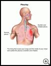 Thumbnail image of: Pleurisy: Illustration