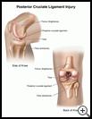 Thumbnail image of: Posterior Cruciate Ligament Injury: Illustration