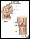 Thumbnail image of: Posterior Cruciate Ligament Injury: Illustration