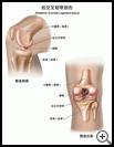 Thumbnail image of: Posterior Cruciate Ligament Injury: Illustration