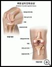 Thumbnail image of: Posterior Cruciate Ligament Injury: Illustration