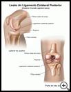 Thumbnail image of: Posterior Cruciate Ligament Injury: Illustration