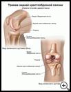Thumbnail image of: Posterior Cruciate Ligament Injury: Illustration