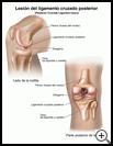 Thumbnail image of: Posterior Cruciate Ligament Injury: Illustration
