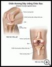 Thumbnail image of: Posterior Cruciate Ligament Injury: Illustration