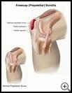 Thumbnail image of: Kneecap (Prepatellar) Bursitis: Illustration