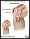 Thumbnail image of: Kneecap (Prepatellar) Bursitis: Illustration