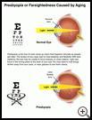 Thumbnail image of: Presbyopia or Farsightedness Caused by Aging: Illustration