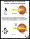 Thumbnail image of: Presbyopia or Farsightedness Caused by Aging: Illustration
