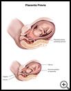 Thumbnail image of: Placenta Previa: Illustration