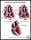 Thumbnail image of: Mitral Valve, Normal and Prolapsed: Illustration