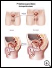 Thumbnail image of: Enlarged Prostate: Illustration