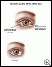 Thumbnail image of: Growth on the White of the Eye: Illustration