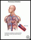 Thumbnail image of: Pulmonary Embolism: Illustration