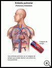 Thumbnail image of: Pulmonary Embolism: Illustration