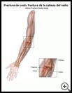 Thumbnail image of: Elbow Fracture, Radial Head: Illustration