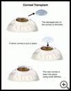 Thumbnail image of: Corneal Transplant: Illustration