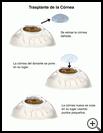 Thumbnail image of: Corneal Transplant: Illustration
