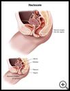 Thumbnail image of: Rectocele: Illustration