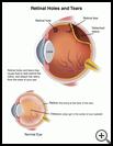 Thumbnail image of: Retinal Holes and Tears: Illustration