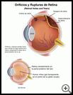 Thumbnail image of: Retinal Holes and Tears: Illustration