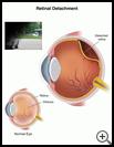 Thumbnail image of: Retinal Detachment: Illustration