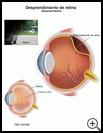 Thumbnail image of: Retinal Detachment: Illustration