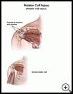Thumbnail image of: Rotator Cuff Injury: Illustration