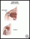 Thumbnail image of: Rotator Cuff Injury: Illustration
