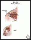 Thumbnail image of: Rotator Cuff Injury: Illustration