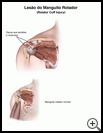 Thumbnail image of: Rotator Cuff Injury: Illustration