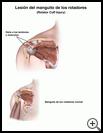 Thumbnail image of: Rotator Cuff Injury: Illustration
