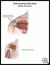 Thumbnail image of: Rotator Cuff Injury: Illustration