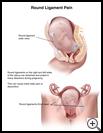 Thumbnail image of: Round Ligament Pain: Illustration