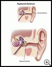 Thumbnail image of: Ruptured Eardrum: Illustration