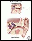 Thumbnail image of: Ruptured Eardrum: Illustration