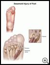 Thumbnail image of: Sesamoid Injury of the Foot: Illustration