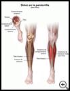 Thumbnail image of: Shin Pain (Shin Splints): Illustration