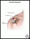Thumbnail image of: Shoulder Separation: Illustration