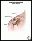 Thumbnail image of: Shoulder Separation: Illustration