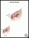 Thumbnail image of: Shoulder Bursitis: Illustration