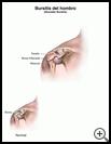 Thumbnail image of: Shoulder Bursitis: Illustration