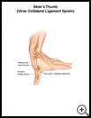 Thumbnail image of: Skier's Thumb (Ulnar Collateral Ligament Sprain): Illustration