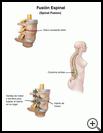 Thumbnail image of: Spinal Fusion: Illustration