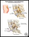 Thumbnail image of: Spondylolysis and Spondylolisthesis: Illustration