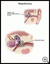 Thumbnail image of: Stapedectomy: Illustration