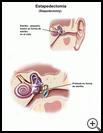 Thumbnail image of: Stapedectomy: Illustration
