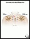 Thumbnail image of: Sternoclavicular Joint Separation: Illustration